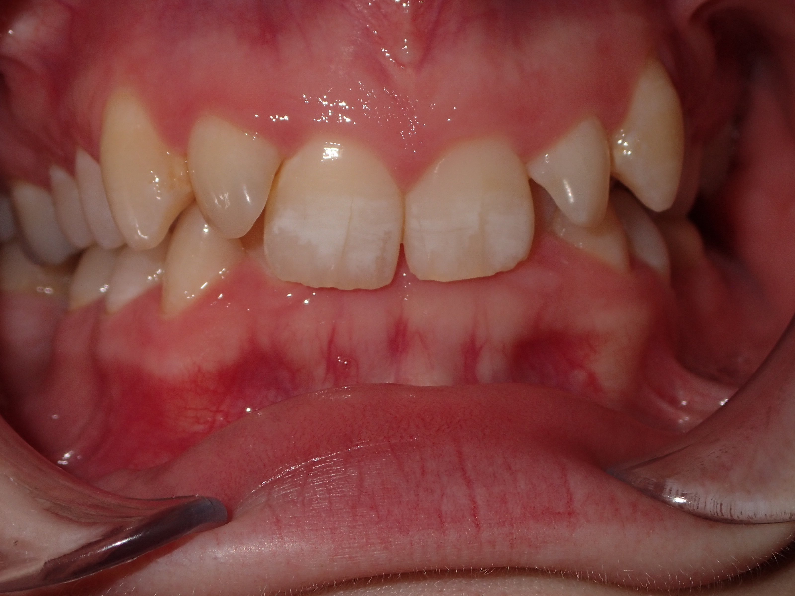 Eldora Family Dentistry & Orthodontics | Ceramic Crowns, Dentures and Night Guards