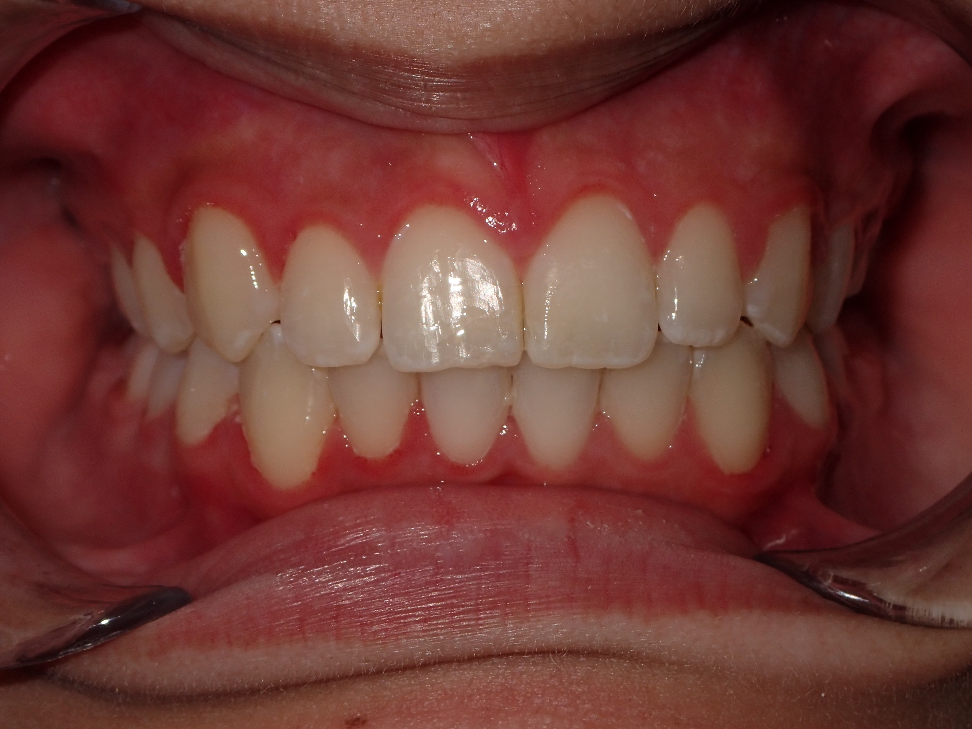 Eldora Family Dentistry & Orthodontics | Dental Sealants, Preventative Program and Sports Mouthguards