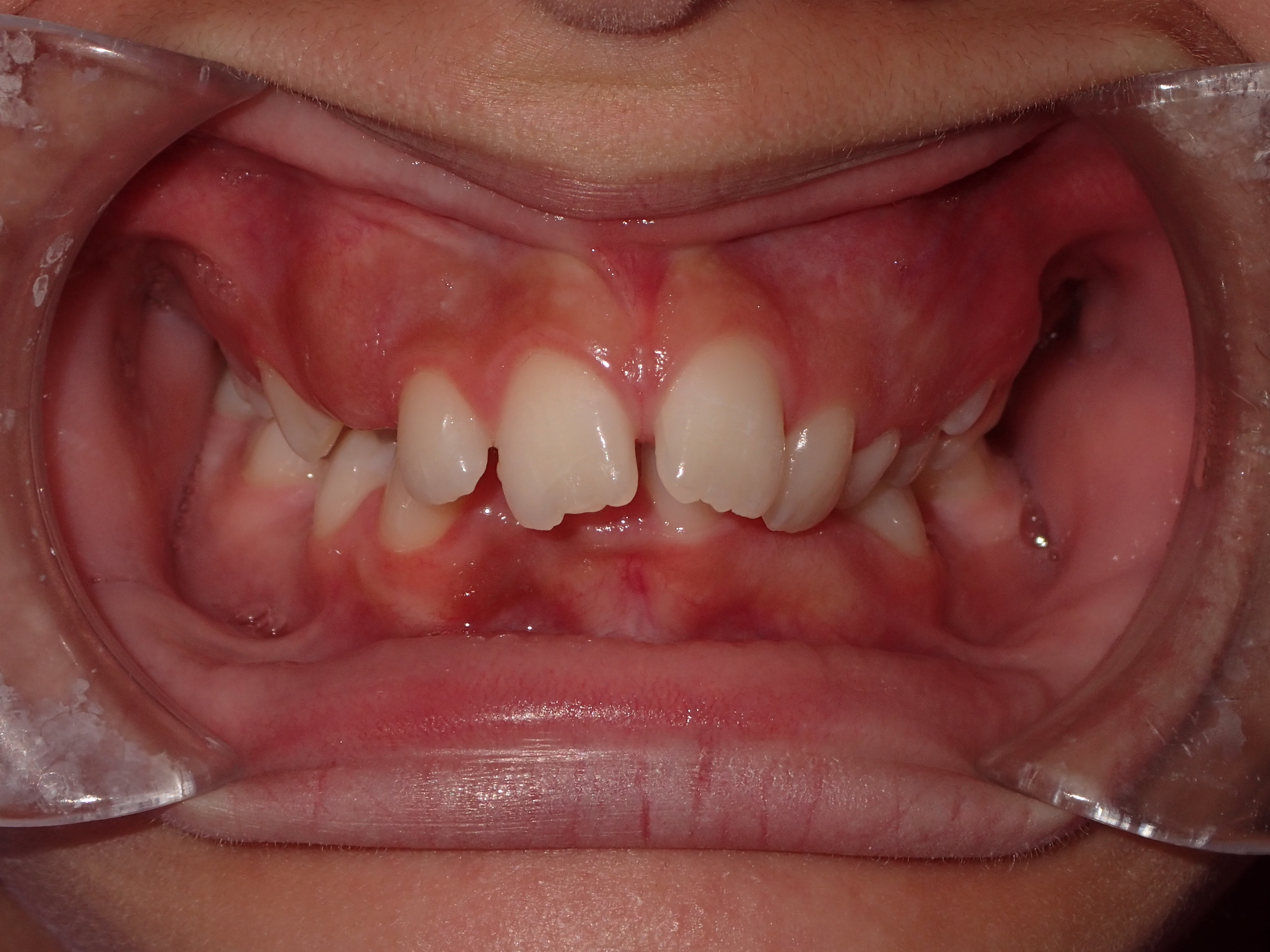 Eldora Family Dentistry & Orthodontics | Implant Dentistry, Fluoride Treatment and Sports Mouthguards