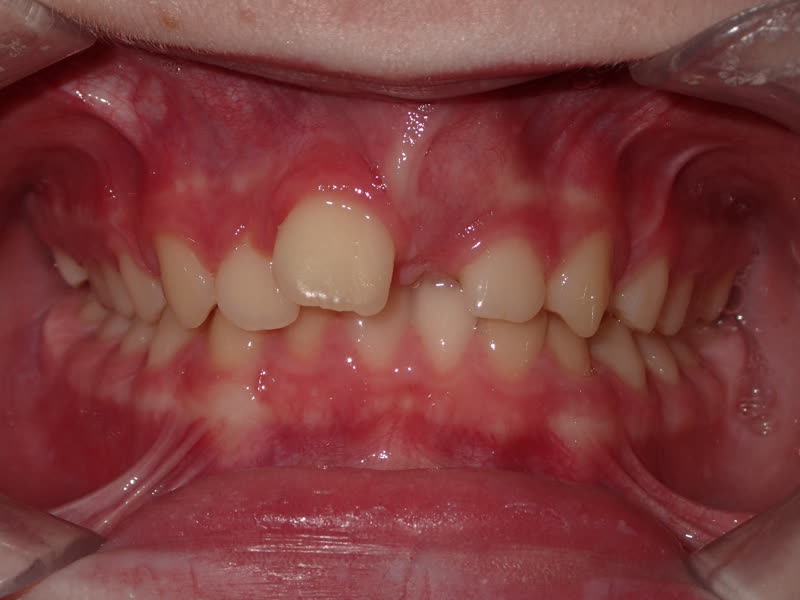 Eldora Family Dentistry   Orthodontics | Periodontal Treatment, Oral Cancer Screening and Perio Protect reg 