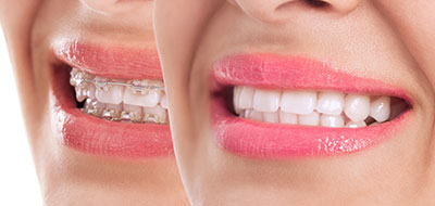 Eldora Family Dentistry   Orthodontics | Dental Cleanings, Dental Fillings and Emergency Treatment