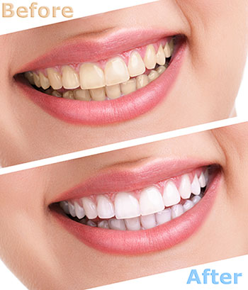 Eldora Family Dentistry   Orthodontics | Cosmetic Dentistry, Ceramic Crowns and Dental Fillings