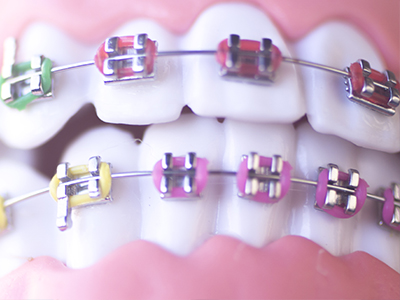 Eldora Family Dentistry   Orthodontics